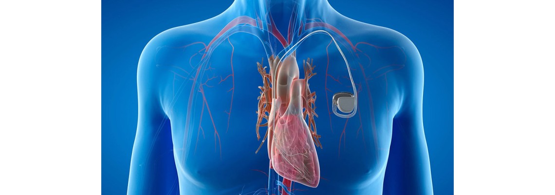 The impact of magnetic fields on pacemakers