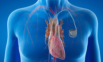 The impact of magnetic fields on pacemakers